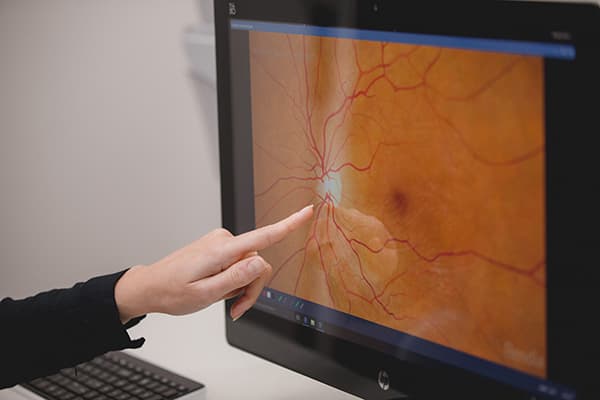 macular degeneration