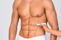 liposuction