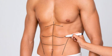 liposuction