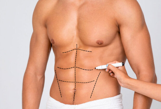 liposuction